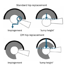 a descriptive picture showing the difference in jump distance between  standard bearing and  dual mobility hip implants