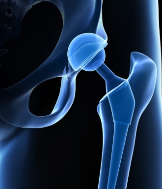 Xray of the MDM Hip mobility system inside of a femor